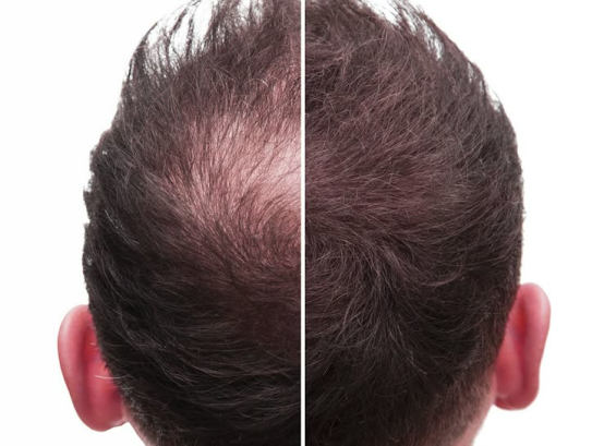 Before and after photo shared by Marco D.