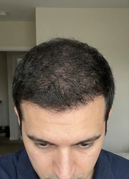 Crown coverage — After