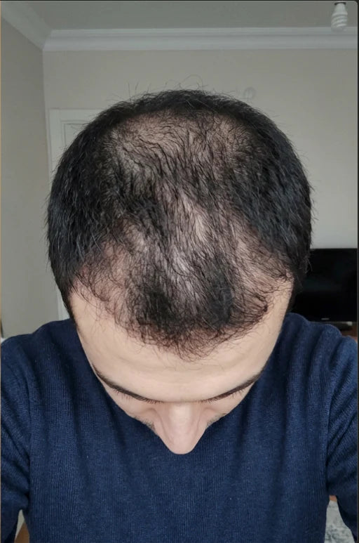 Crown coverage — Before