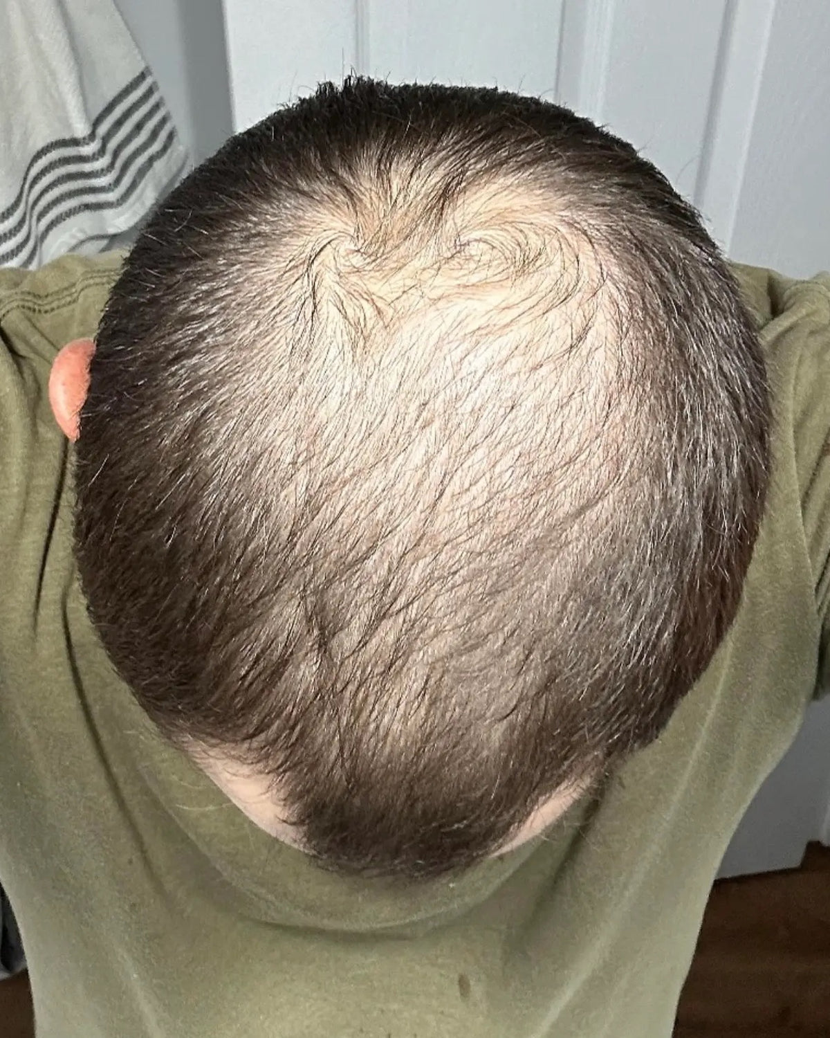 Crown density — Before
