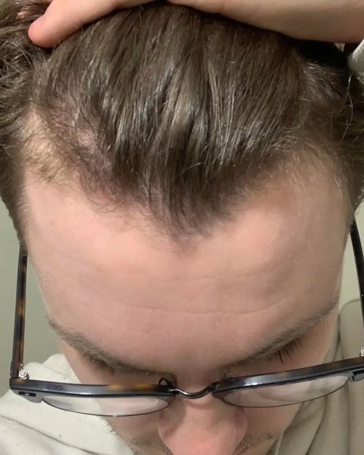 Frontal hairline — After