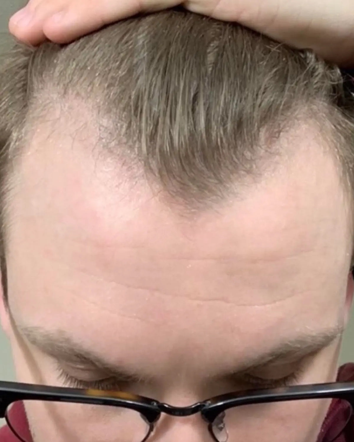 Frontal hairline — Before